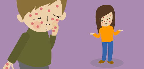 chickenpox